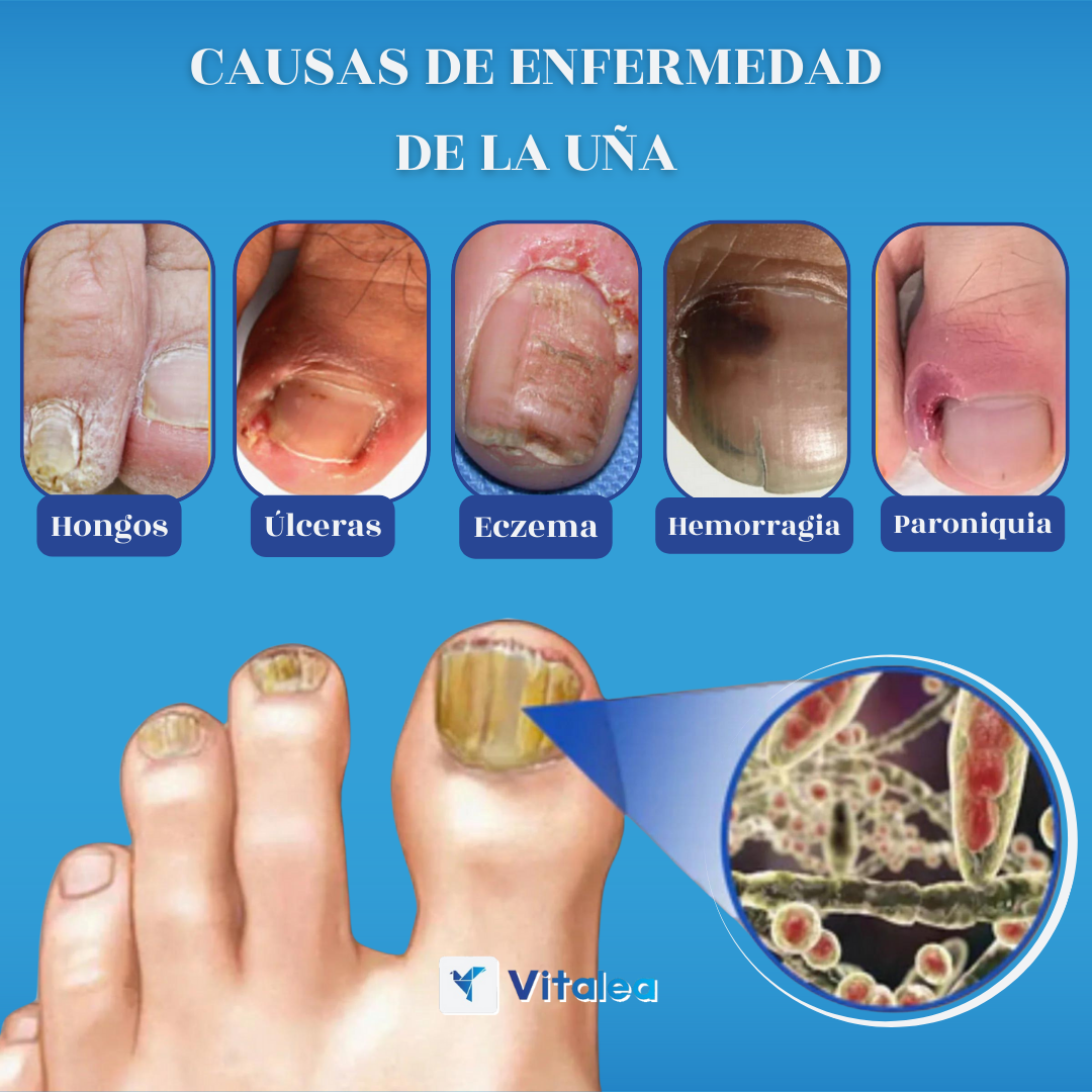 Sprej proti plesniam🧫NailFungus™| 1+1 ZDARMA