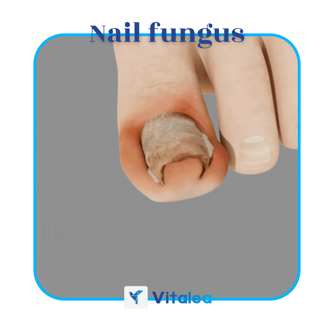 Sprej proti plesniam🧫NailFungus™| 1+1 ZDARMA