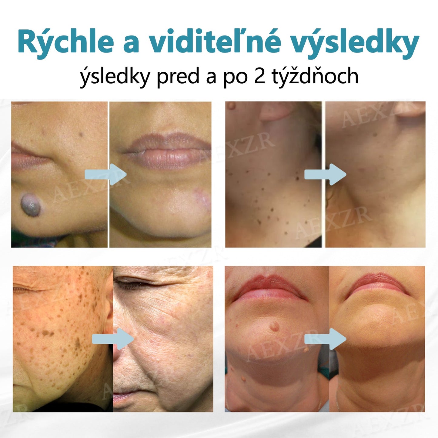 Bikenda® Neinvazívne laserové pero na odstránenie znamienok a bradavíc💥