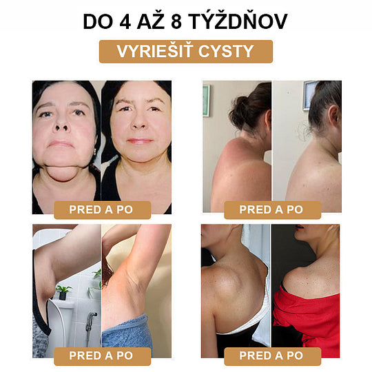 【✨Dobirka✨】2024 Nový ultrazvukový liposukčný detoxikačný náramok SlimPulse™(Odporúčanie lekára👨⚕)