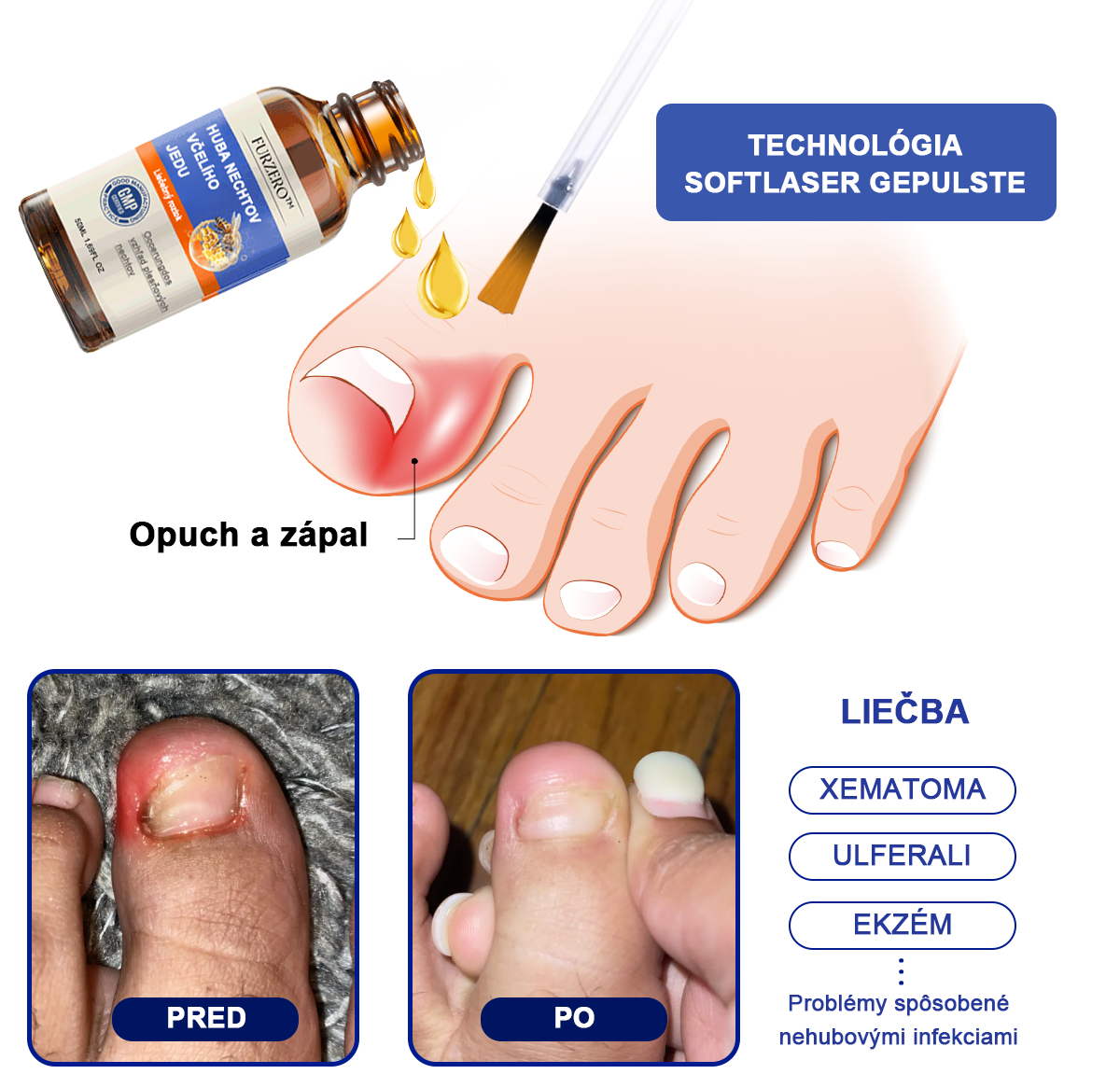 🐝🐝🐝Furzero™ Včelí jed na plesne na nechtoch: kompletné riešenie plesní na nechtoch 🌟👣