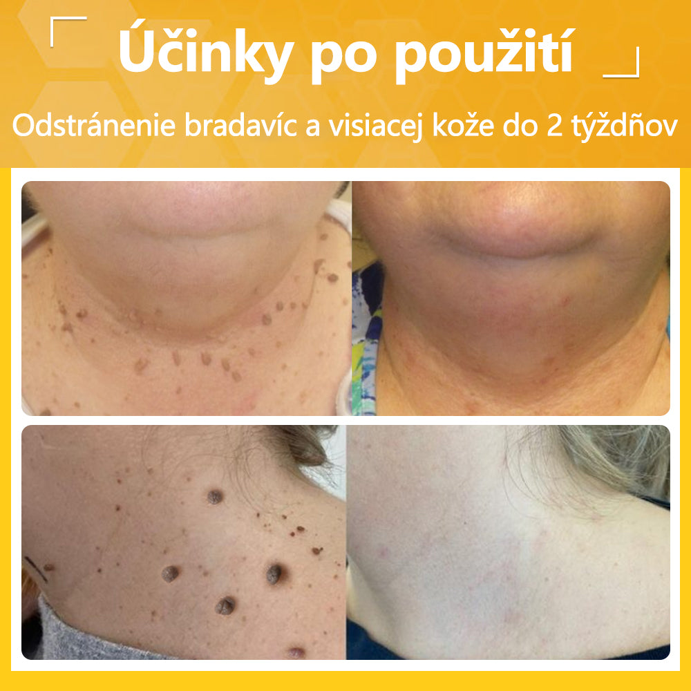 ✅flysmus® Silný krém s včelím jedom – Odporúčaný dermatologickými odborníkmi. Účinný proti bradaviciam, hrčkám, léziám, infekciám a jazvám.🐝
