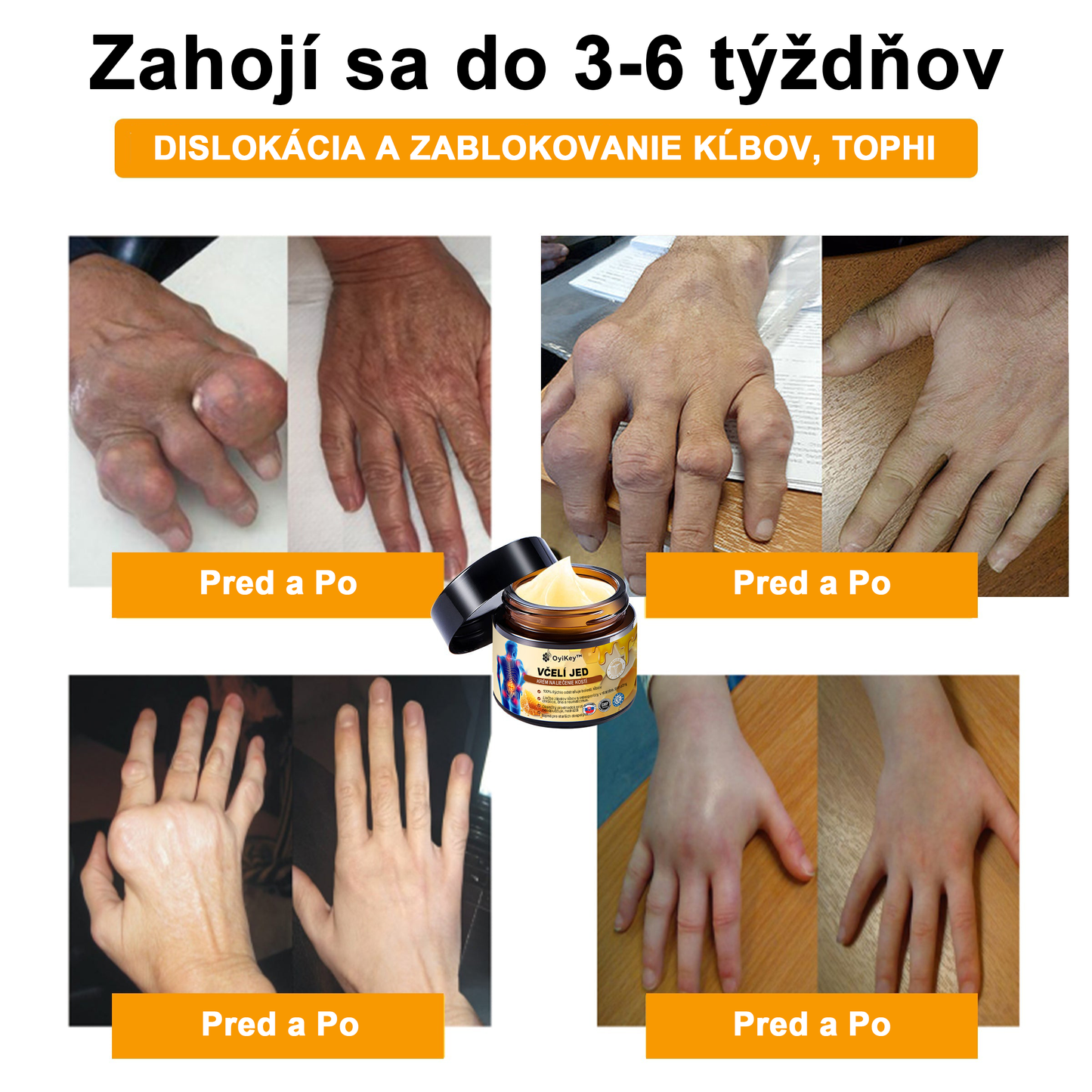 【Oficiálny obchod】 𝗔𝗲𝘁𝗵𝗲𝗿𝗶𝘀™ Včelí jed Ultra Krém na úľavu od bolesti-(Poskytuje odstránenie bolesti pri artritíde, bolesti svalov, chrbta, kolien, chrbta, ramien, bokov, zápästí, rúk)