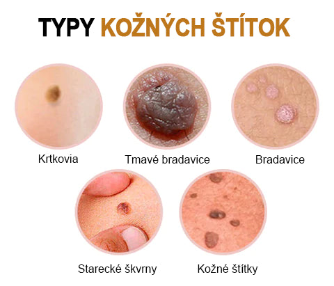 🧡Cvreoz Včelí jed na odstraňovanie bradavíc a značiek v spreji(👨⚕AAD ODPORÚČA)🐝🐝(🔥Posledný deň akcie 80% zľava)