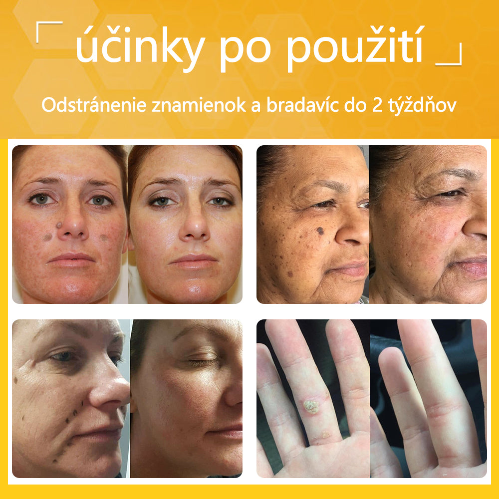 ✅flysmus® Silný krém s včelím jedom – Odporúčaný dermatologickými odborníkmi. Účinný proti bradaviciam, hrčkám, léziám, infekciám a jazvám.🐝