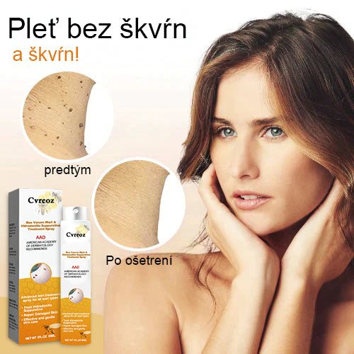 🧡Cvreoz Včelí jed na odstraňovanie bradavíc a značiek v spreji(👨⚕AAD ODPORÚČA)🐝🐝(🔥Posledný deň akcie 80% zľava)