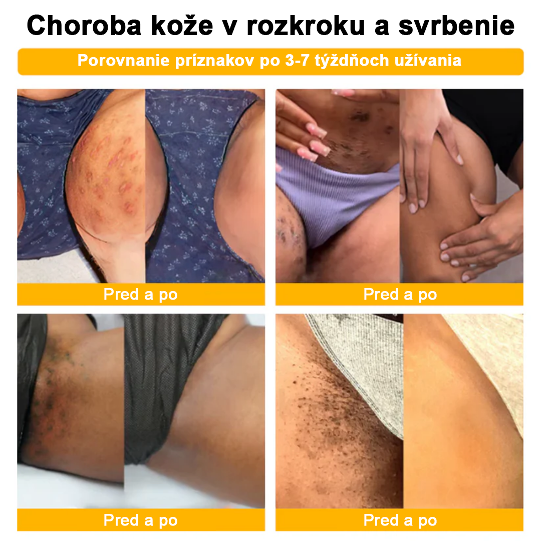 🌈🐝AEXZR™ Krém na liečbu bradavíc zo včelieho jedu