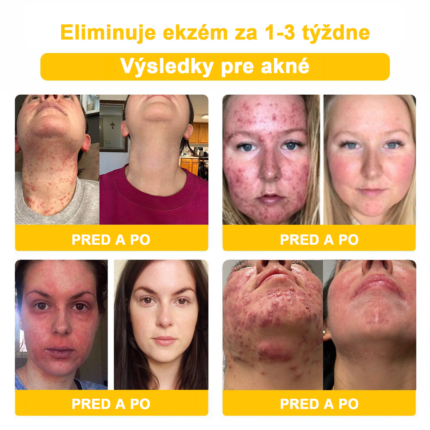 2024 NOVINKA Velisse™ Pleťový krém s včelím jedom(🧑⚕️Odporúča sa AAD), na odstránenie bradavíc, akné a jaziev – lieči viaceré kožné stavy