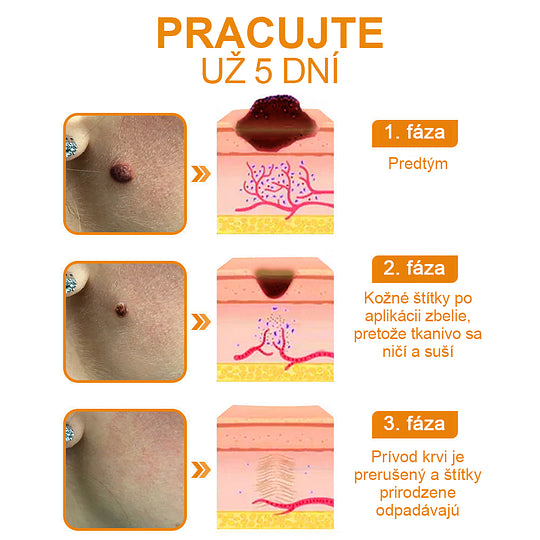 🔥Vsoxa™ Krém na odstránenie bradavíc a krtkov s obsahom včelieho jedu (zľava 80%)