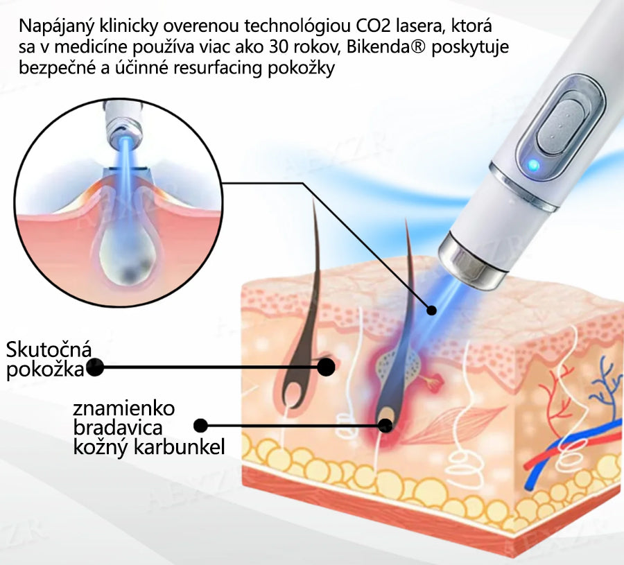 Bikenda® Neinvazívne laserové pero na odstránenie znamienok a bradavíc💥