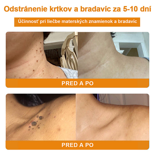 🔥Vsoxa™ Krém na odstránenie bradavíc a krtkov s obsahom včelieho jedu (zľava 80%)