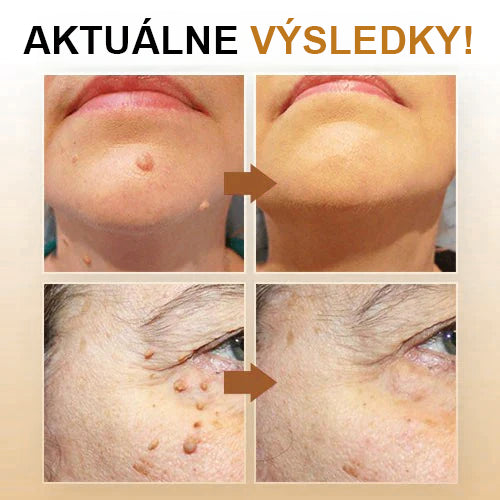 🧡Cvreoz Včelí jed na odstraňovanie bradavíc a značiek v spreji(👨⚕AAD ODPORÚČA)🐝🐝(🔥Posledný deň akcie 80% zľava)