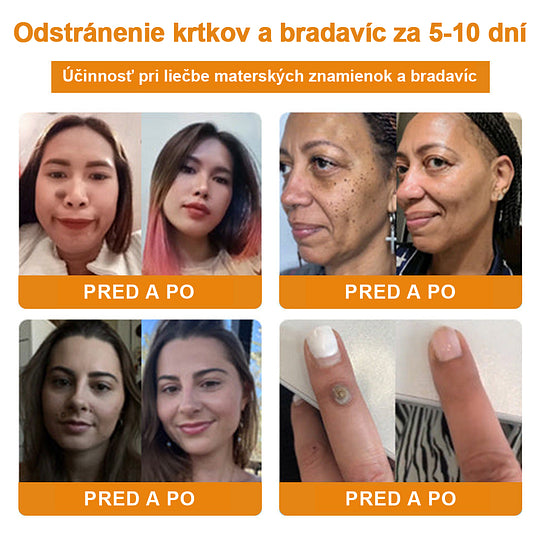 🔥Vsoxa™ Krém na odstránenie bradavíc a krtkov s obsahom včelieho jedu (zľava 80%)