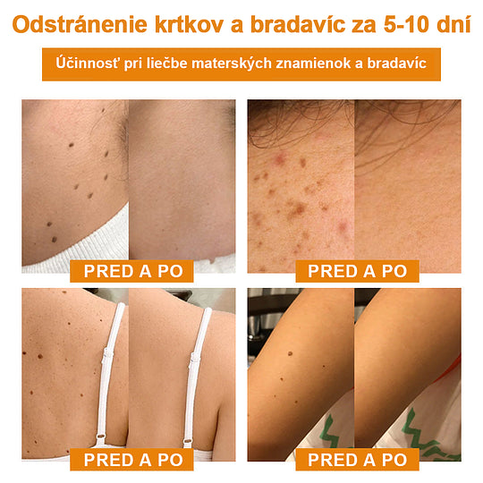 🔥Vsoxa™ Krém na odstránenie bradavíc a krtkov s obsahom včelieho jedu (zľava 80%)