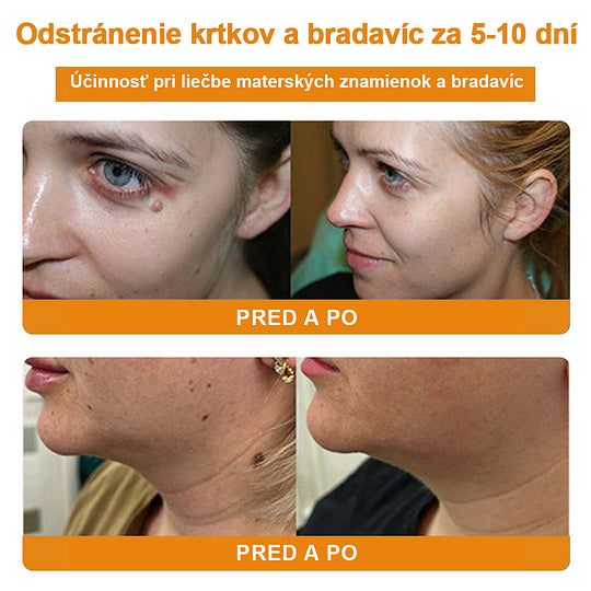 🔥Vsoxa™ Krém na odstránenie bradavíc a krtkov s obsahom včelieho jedu (zľava 80%)