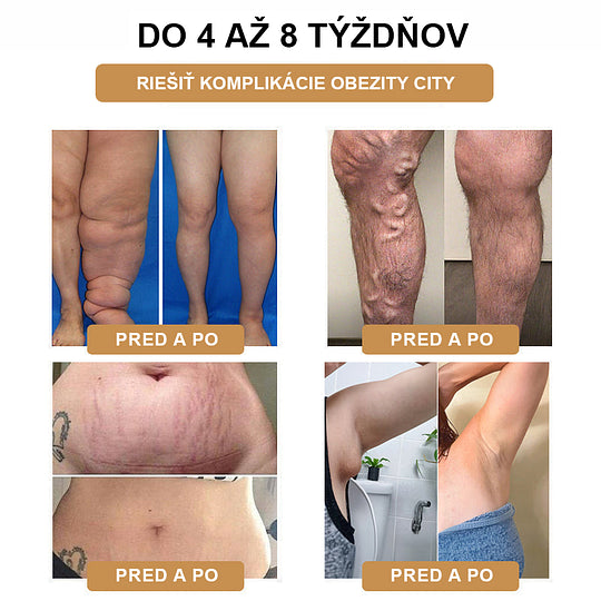 【✨Dobirka✨】2024 Nový ultrazvukový liposukčný detoxikačný náramok SlimPulse™(Odporúčanie lekára👨⚕)