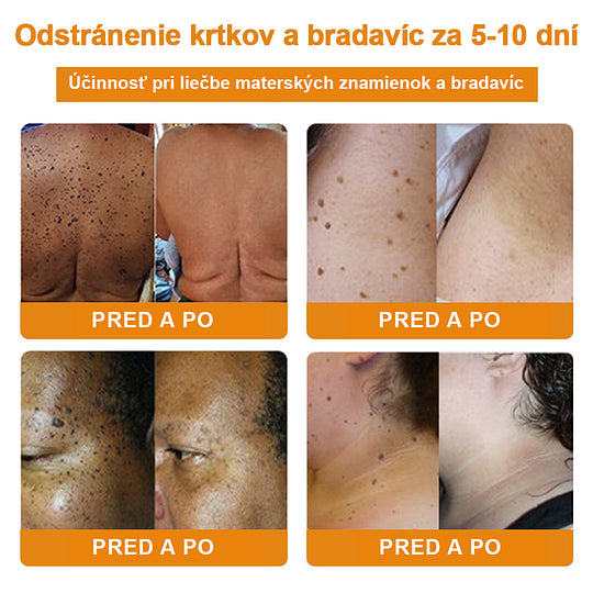 🔥Vsoxa™ Krém na odstránenie bradavíc a krtkov s obsahom včelieho jedu (zľava 80%)