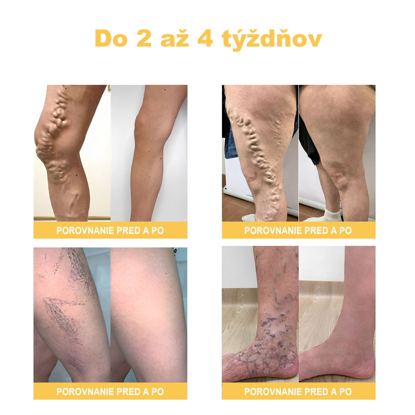 🏆🌈[✨Oficiálny obchod značky✨]Zoencgz™ Krém na liečbu artritídy a kŕčových žíl so včelím jedom（AVLS & ACR RECOMMENDS）