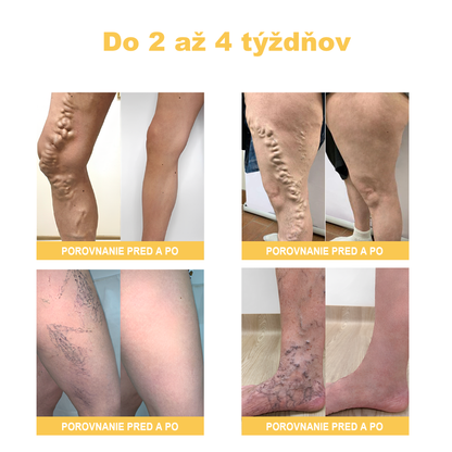 🏆🌈[✨Oficiálny obchod značky✨]Zoencgz™ Krém na liečbu artritídy a kŕčových žíl so včelím jedom（AVLS & ACR RECOMMENDS）
