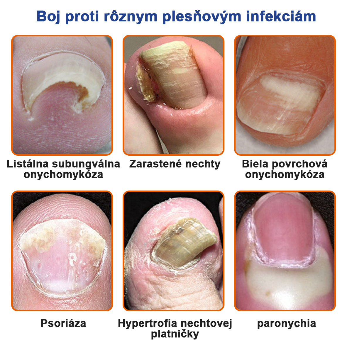 🐝🐝🐝Furzero™ Včelí jed na plesne na nechtoch: kompletné riešenie plesní na nechtoch 🌟👣