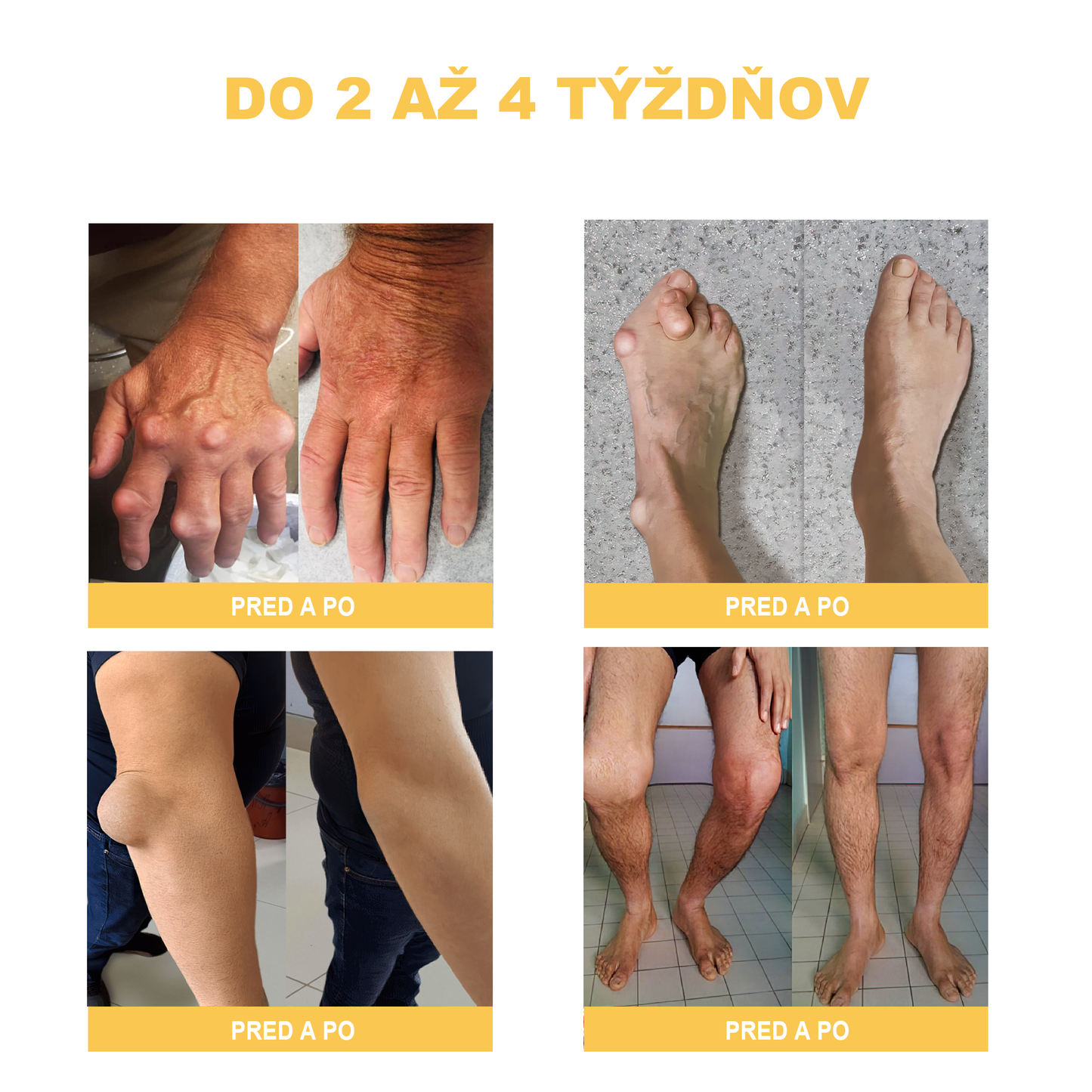 🏆🌈[✨Oficiálny obchod značky✨]Zoencgz™ Krém na liečbu artritídy a kŕčových žíl so včelím jedom（AVLS & ACR RECOMMENDS）