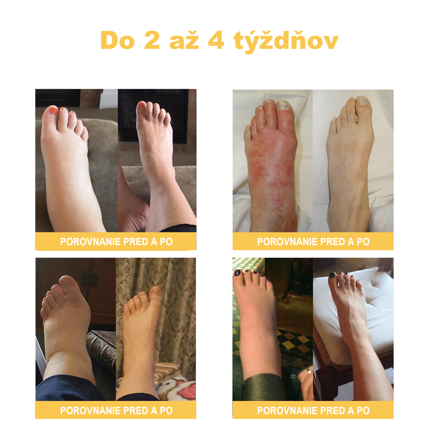 🏆🌈[✨Oficiálny obchod značky✨]Zoencgz™ Krém na liečbu artritídy a kŕčových žíl so včelím jedom（AVLS & ACR RECOMMENDS）