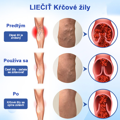 🌱🌠✨Sprej na liečbu kŕčových žíl Veinhealing™🌿