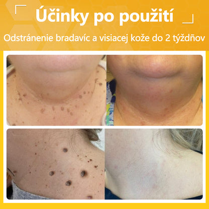 ✅flysmus® Silný krém s včelím jedom – Odporúčaný dermatologickými odborníkmi. Účinný proti bradaviciam, hrčkám, léziám, infekciám a jazvám.🐝🐝