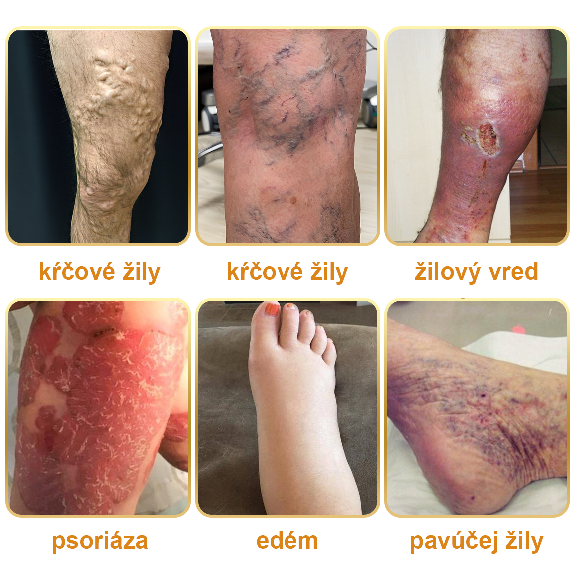 🏆🌈[✨Oficiálny obchod značky✨]Zoencgz™ Krém na liečbu artritídy a kŕčových žíl so včelím jedom（AVLS & ACR RECOMMENDS）