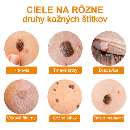 🔥Vsoxa™ Krém na odstránenie bradavíc a krtkov s obsahom včelieho jedu (zľava 80%)