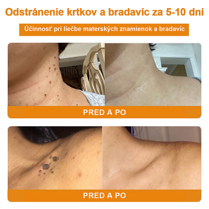 🔥Vsoxa™ Krém na odstránenie bradavíc a krtkov s obsahom včelieho jedu (zľava 80%)